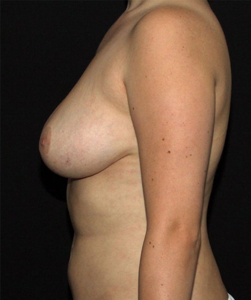 Breast Reduction Before & After Gallery - Patient 133023462 - Image 6