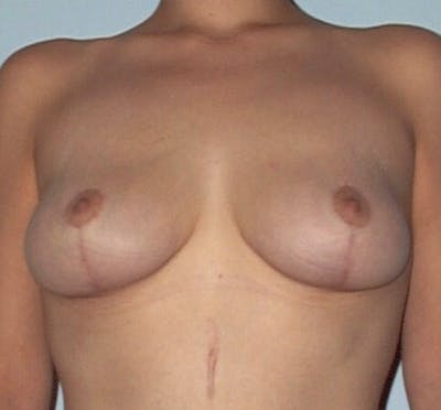 Breast Lift Before & After Gallery - Patient 133023466 - Image 2