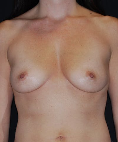 Breast Augmentation Before & After Gallery - Patient 133023472 - Image 1