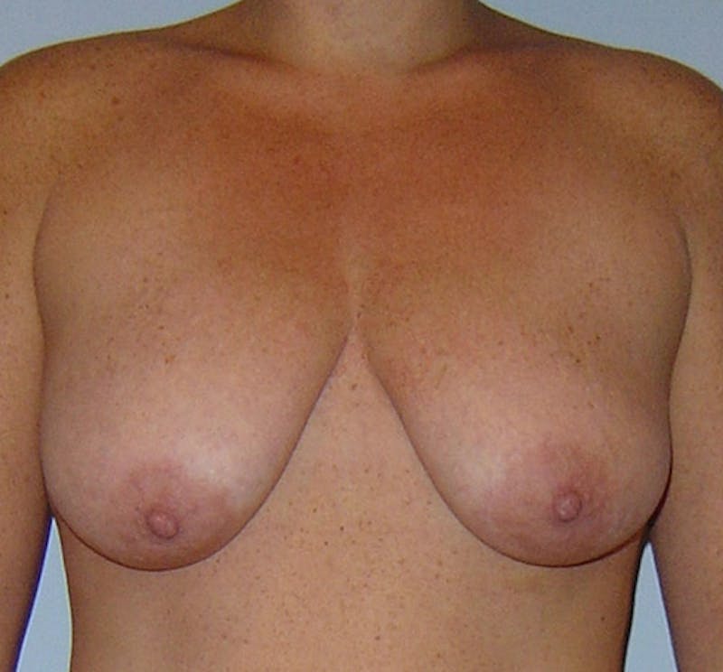 Breast Lift Before & After Gallery - Patient 133023468 - Image 1