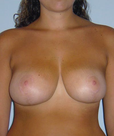 Breast Reduction Before & After Gallery - Patient 133023469 - Image 2