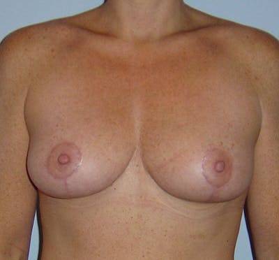 Breast Lift Before & After Gallery - Patient 133023468 - Image 2