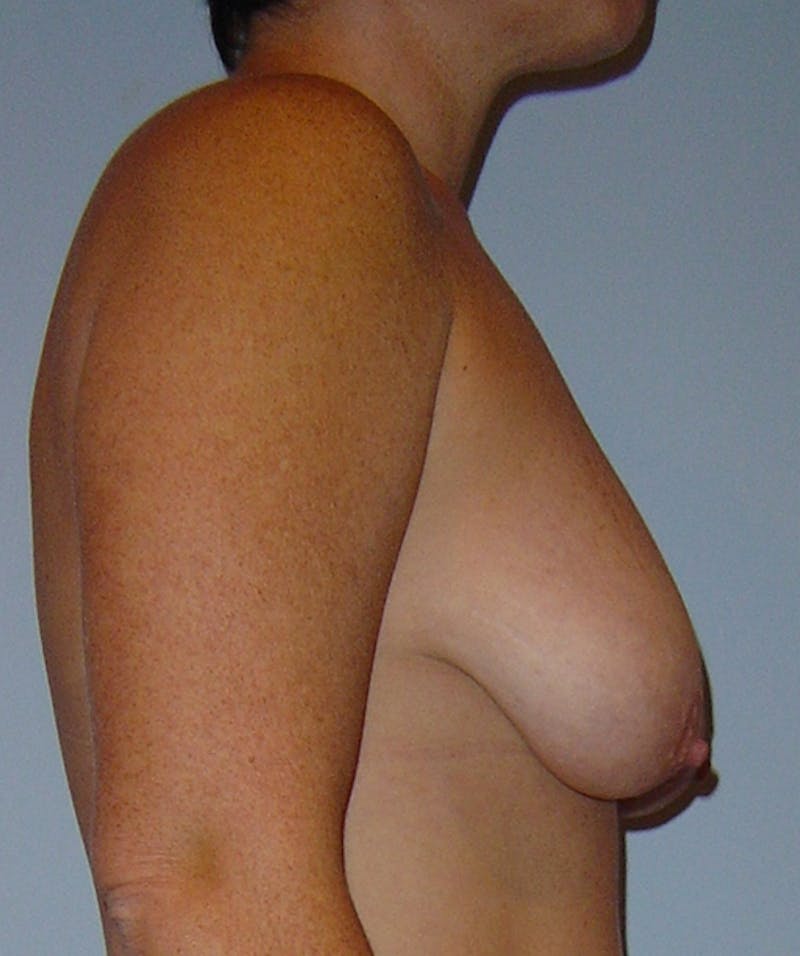 Breast Lift Before & After Gallery - Patient 133023468 - Image 3