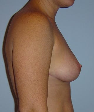 Breast Lift Before & After Gallery - Patient 133023468 - Image 4