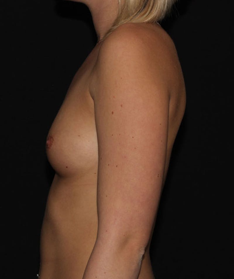 Sientra Breast Implants Before & After Gallery - Patient 133023474 - Image 9
