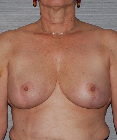 Breast Reduction Before & After Gallery - Patient 133023479 - Image 2