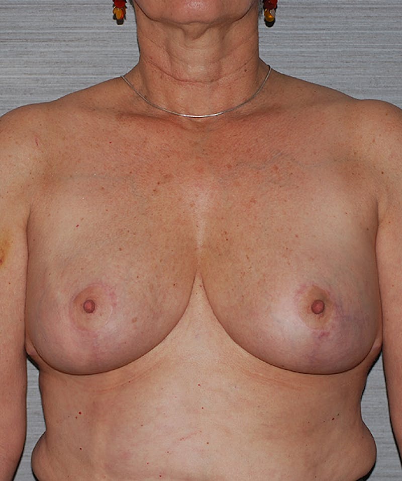 Breast Reduction Before & After Gallery - Patient 133023479 - Image 2