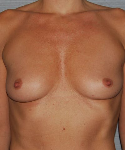 Breast Augmentation Before & After Gallery - Patient 133023484 - Image 1