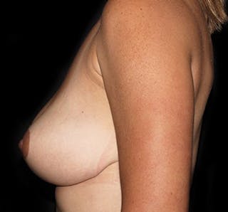 Breast Lift Before & After Gallery - Patient 133023476 - Image 4