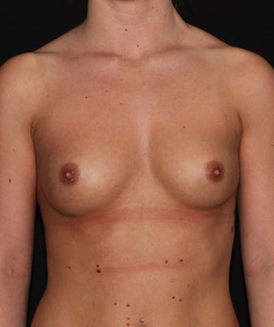 Sientra Breast Implants Before & After Gallery - Patient 133023489 - Image 1