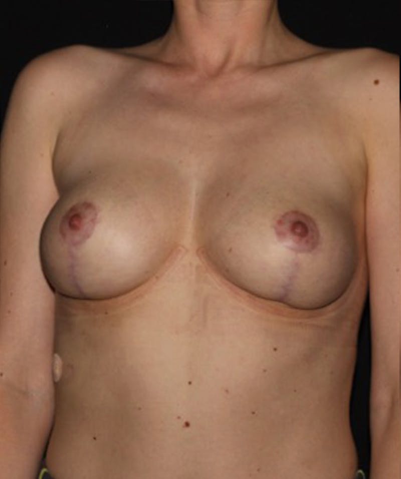 Breast Lift Before & After Gallery - Patient 133023488 - Image 2