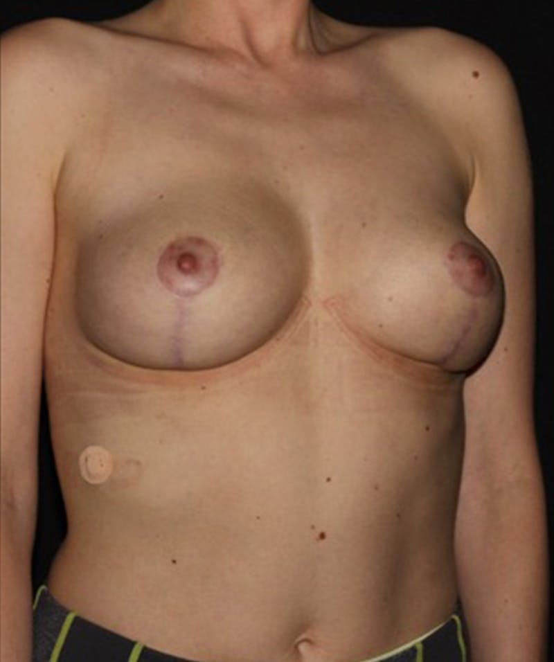 Breast Lift Before & After Gallery - Patient 133023488 - Image 4