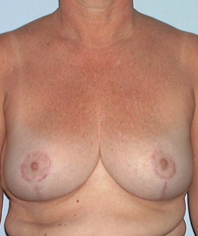Breast Reduction Before & After Gallery - Patient 133023486 - Image 2