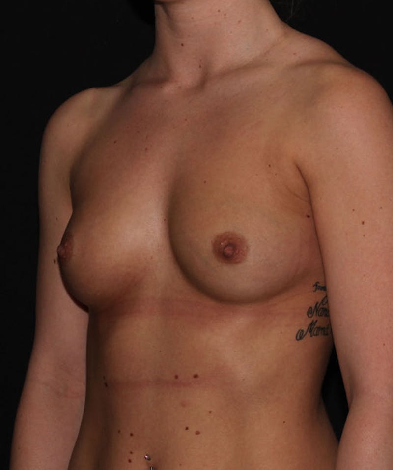 Sientra Breast Implants Before & After Gallery - Patient 133023489 - Image 5