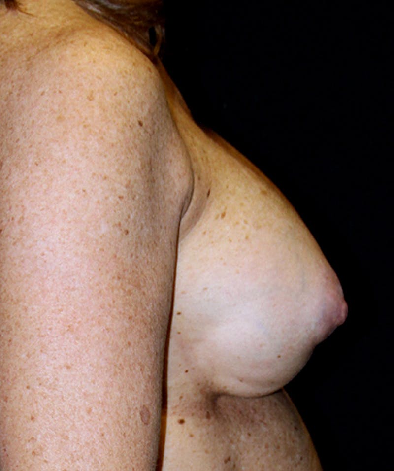 Implant Revision Before & After Gallery - Patient 133023485 - Image 5