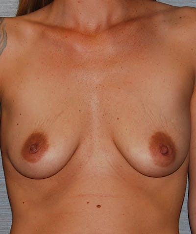 Breast Lift with Implants Before & After Gallery - Patient 133023491 - Image 1