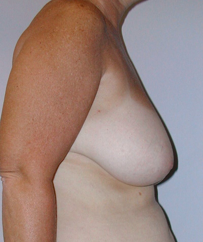 Breast Reduction Before & After Gallery - Patient 133023486 - Image 3