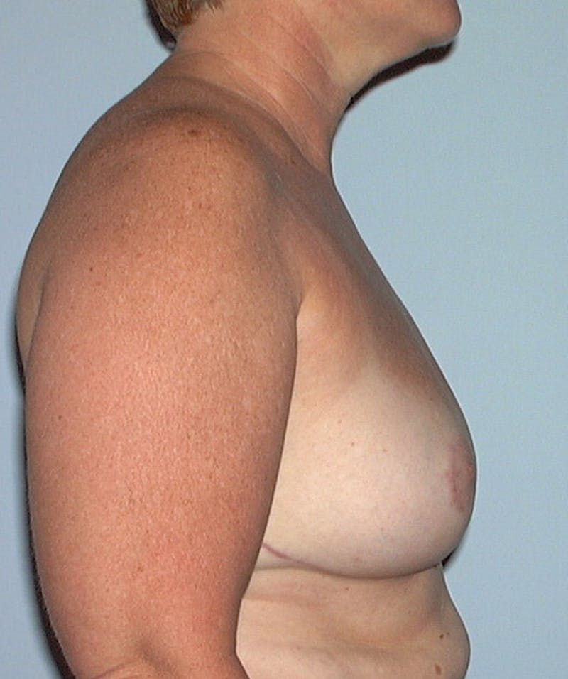 Breast Reduction Before & After Gallery - Patient 133023486 - Image 4