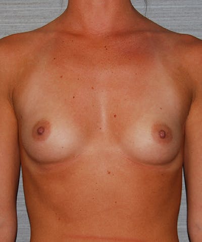 Breast Augmentation Before & After Gallery - Patient 133023492 - Image 1