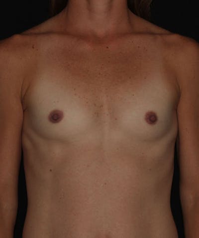 Sientra Breast Implants Before & After Gallery - Patient 133023495 - Image 1