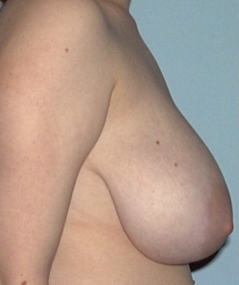 Breast Reduction Before & After Gallery - Patient 133023490 - Image 3