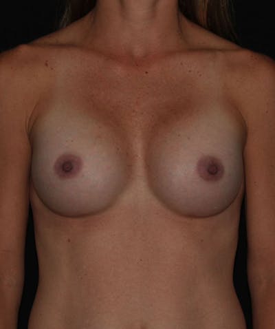 Sientra Breast Implants Before & After Gallery - Patient 133023495 - Image 2