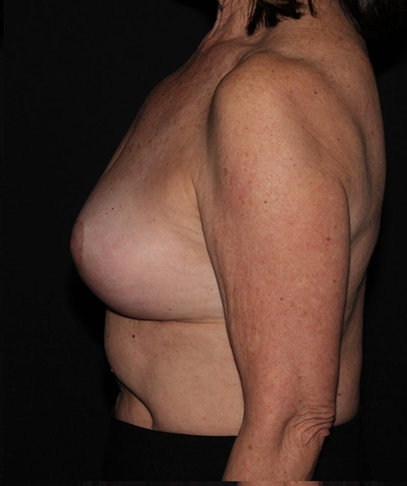 Breast Implant Removal Before & After Gallery - Patient 133023498 - Image 4