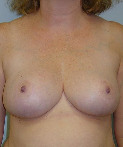 Breast Reduction Before & After Gallery - Patient 133023494 - Image 2