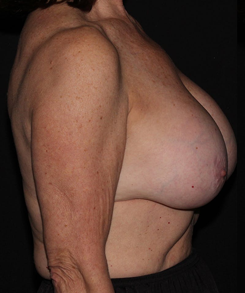 Breast Implant Removal Before & After Gallery - Patient 133023498 - Image 7