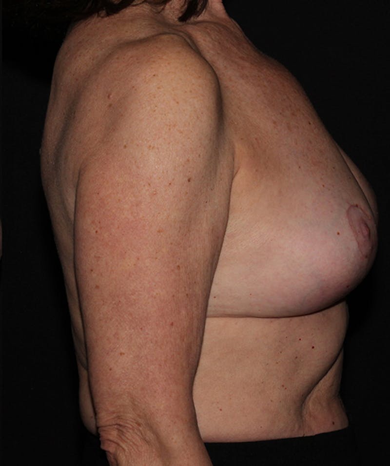 Breast Implant Removal Before & After Gallery - Patient 133023498 - Image 8