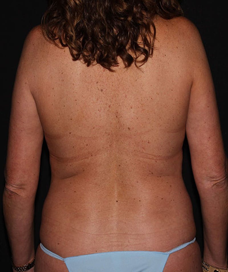 Breast Lift Before & After Gallery - Patient 133023500 - Image 11
