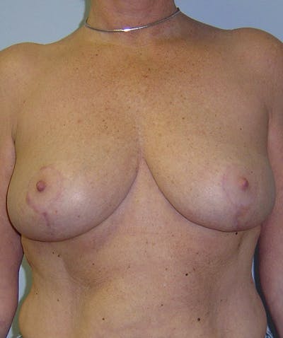 Breast Reduction Before & After Gallery - Patient 133023502 - Image 2