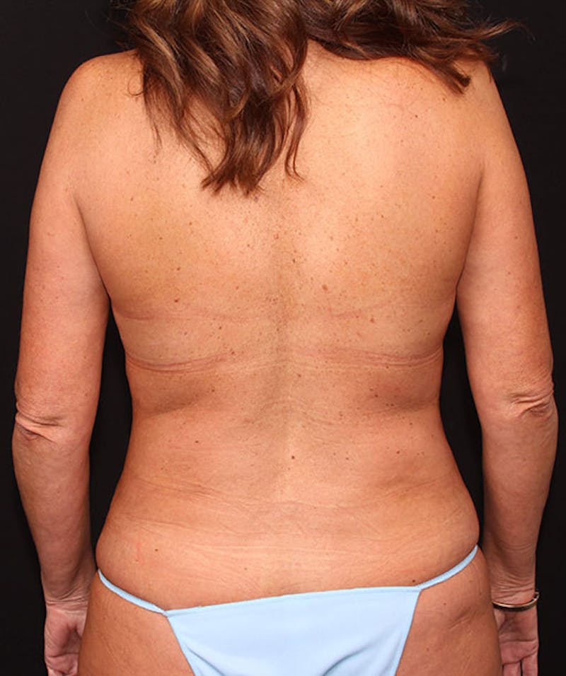 Breast Lift Before & After Gallery - Patient 133023500 - Image 12