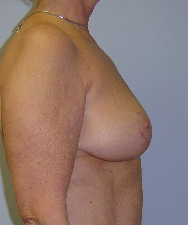 Breast Reduction Before & After Gallery - Patient 133023502 - Image 4