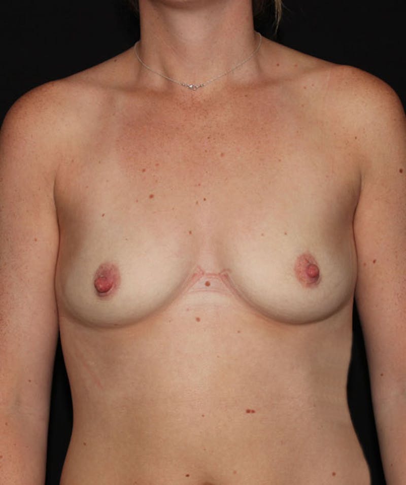 Sientra Breast Implants Before & After Gallery - Patient 133023535 - Image 1