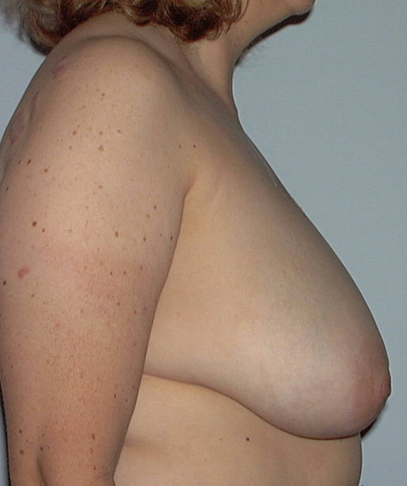 Breast Reduction Before & After Gallery - Patient 133023525 - Image 3