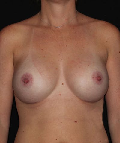 Sientra Breast Implants Before & After Gallery - Patient 133023535 - Image 2