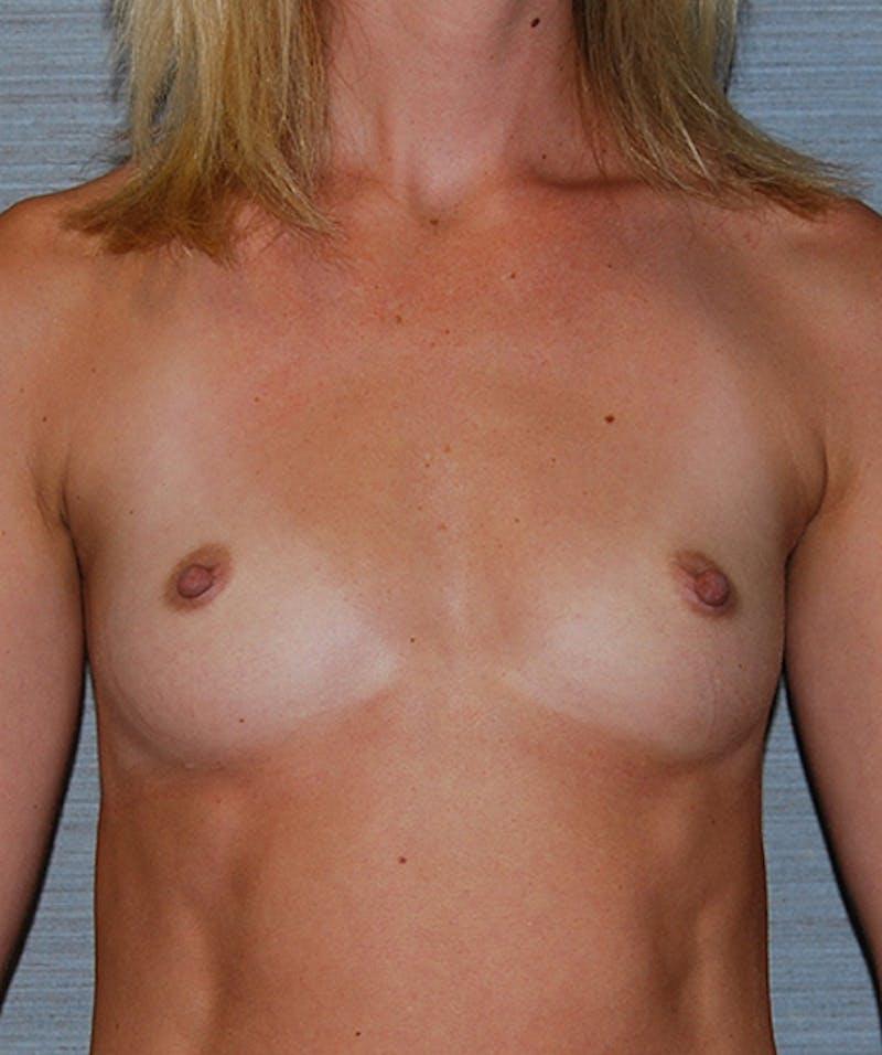 Breast Augmentation Before & After Gallery - Patient 133023532 - Image 1