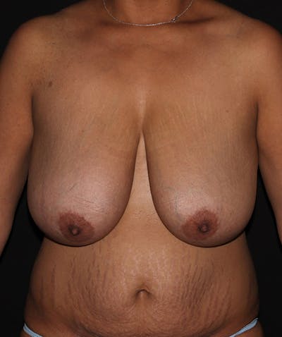Breast Reduction Before & After Gallery - Patient 133023538 - Image 1
