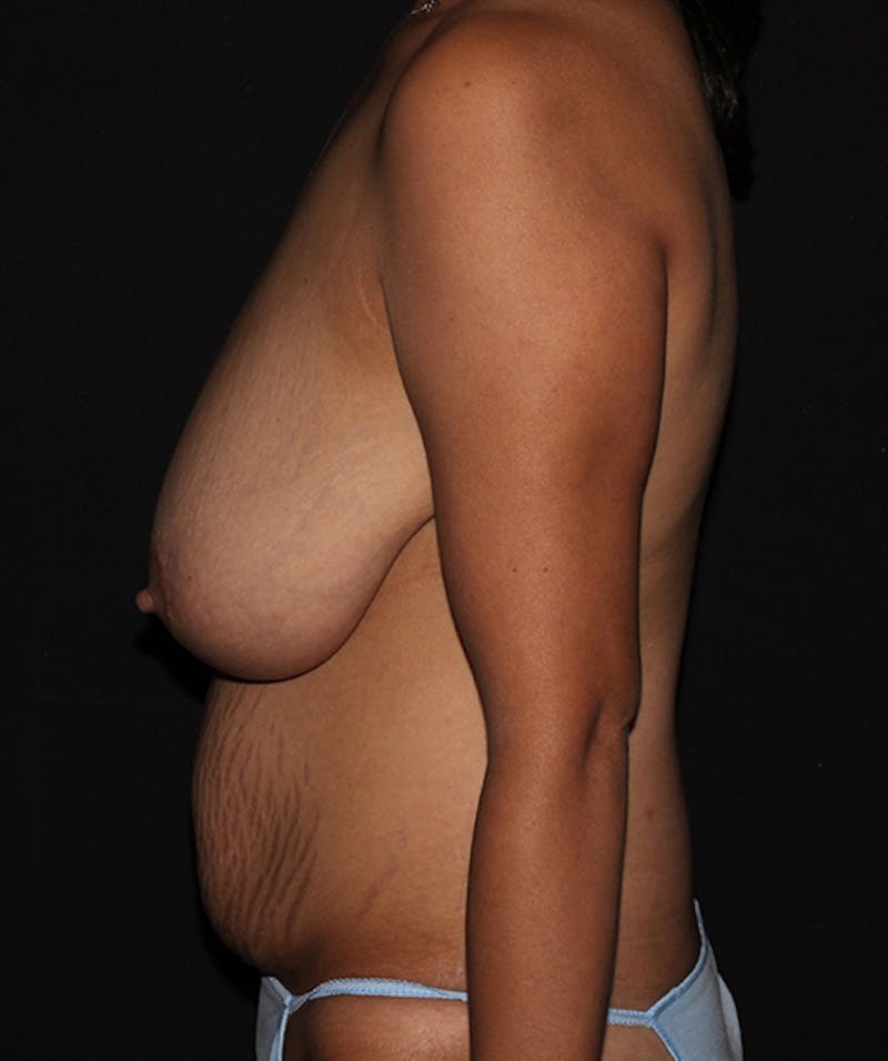 Breast Reduction Before & After Gallery - Patient 133023538 - Image 3