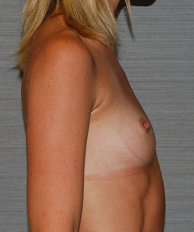 Breast Augmentation Before & After Gallery - Patient 133023532 - Image 5