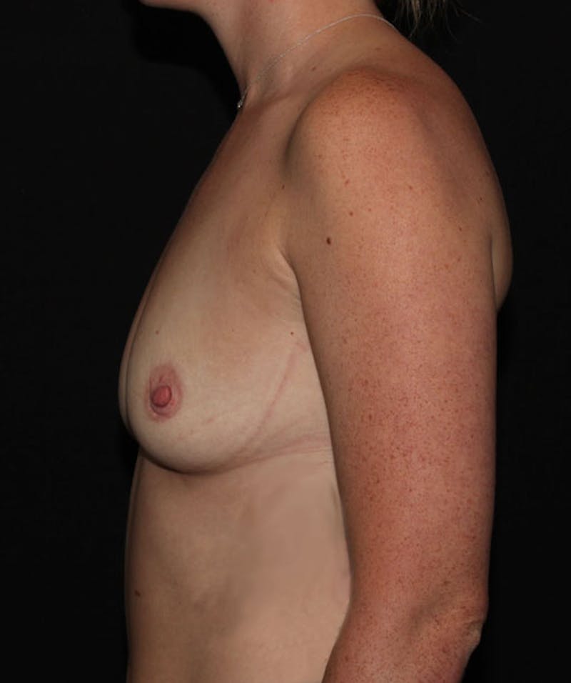 Sientra Breast Implants Before & After Gallery - Patient 133023535 - Image 9