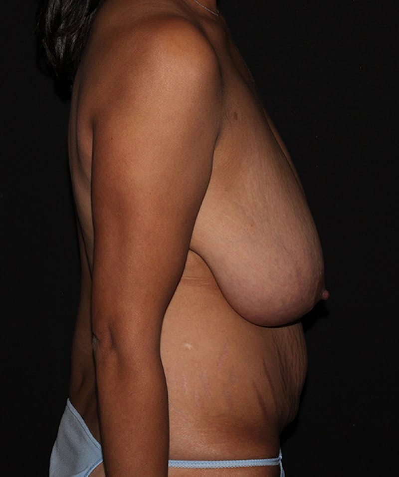 Breast Reduction Before & After Gallery - Patient 133023538 - Image 9