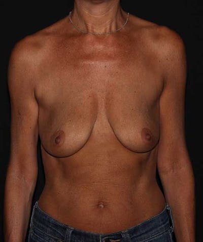 Breast Lift with Implants Before & After Gallery - Patient 133023546 - Image 1