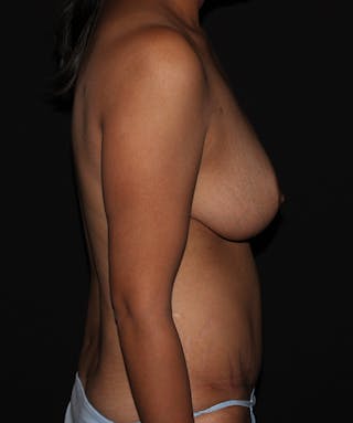 Breast Reduction Before & After Gallery - Patient 133023538 - Image 10