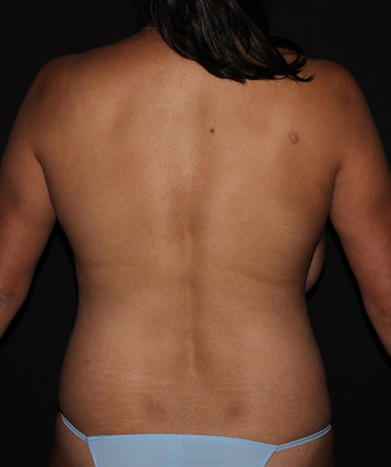 Breast Reduction Before & After Gallery - Patient 133023538 - Image 11