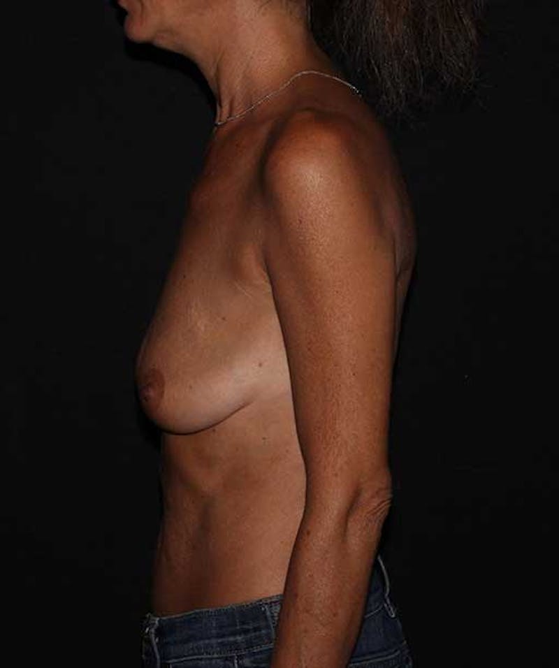 Breast Lift with Implants Before & After Gallery - Patient 133023546 - Image 3