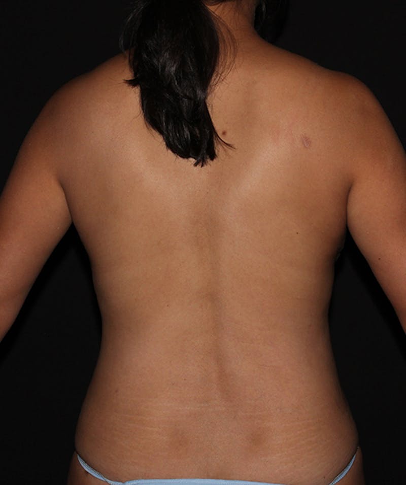 Breast Reduction Before & After Gallery - Patient 133023538 - Image 12