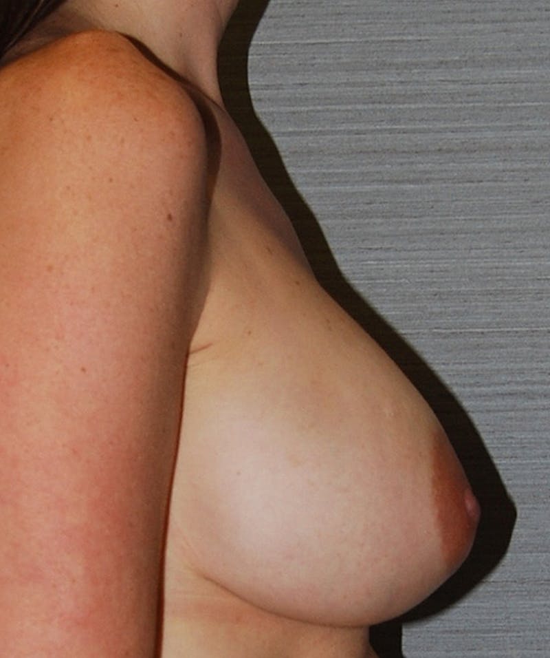 Implant Revision Before & After Gallery - Patient 133023543 - Image 5