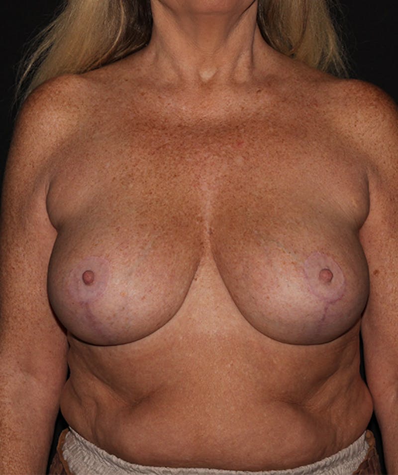 Breast Reduction Before & After Gallery - Patient 133023558 - Image 2